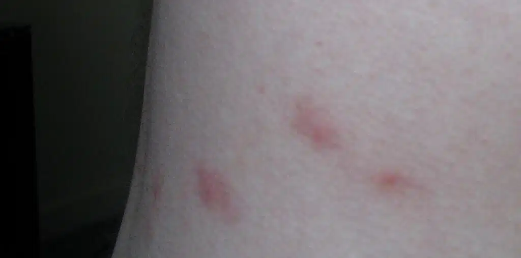 Flea bite marks